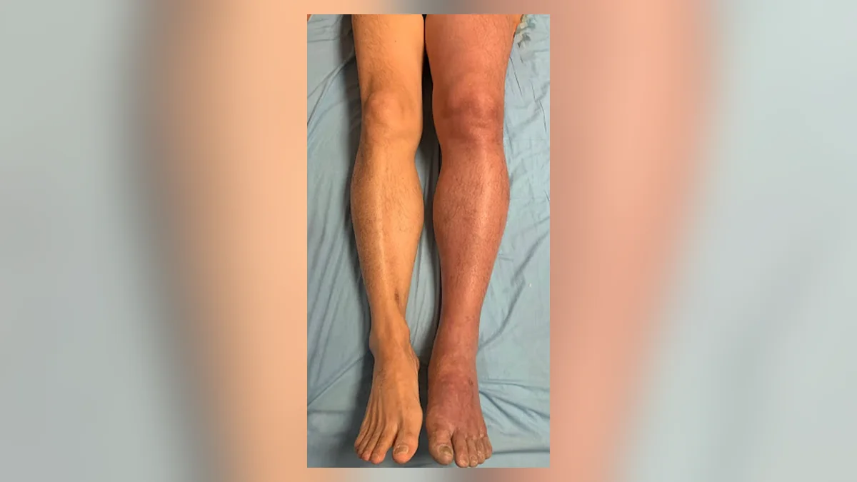 Dua kaki berdampingan di atas ranjang periksa: kaki kanan bengkak dan kemerahan dibandingkan kaki kiri yang normal