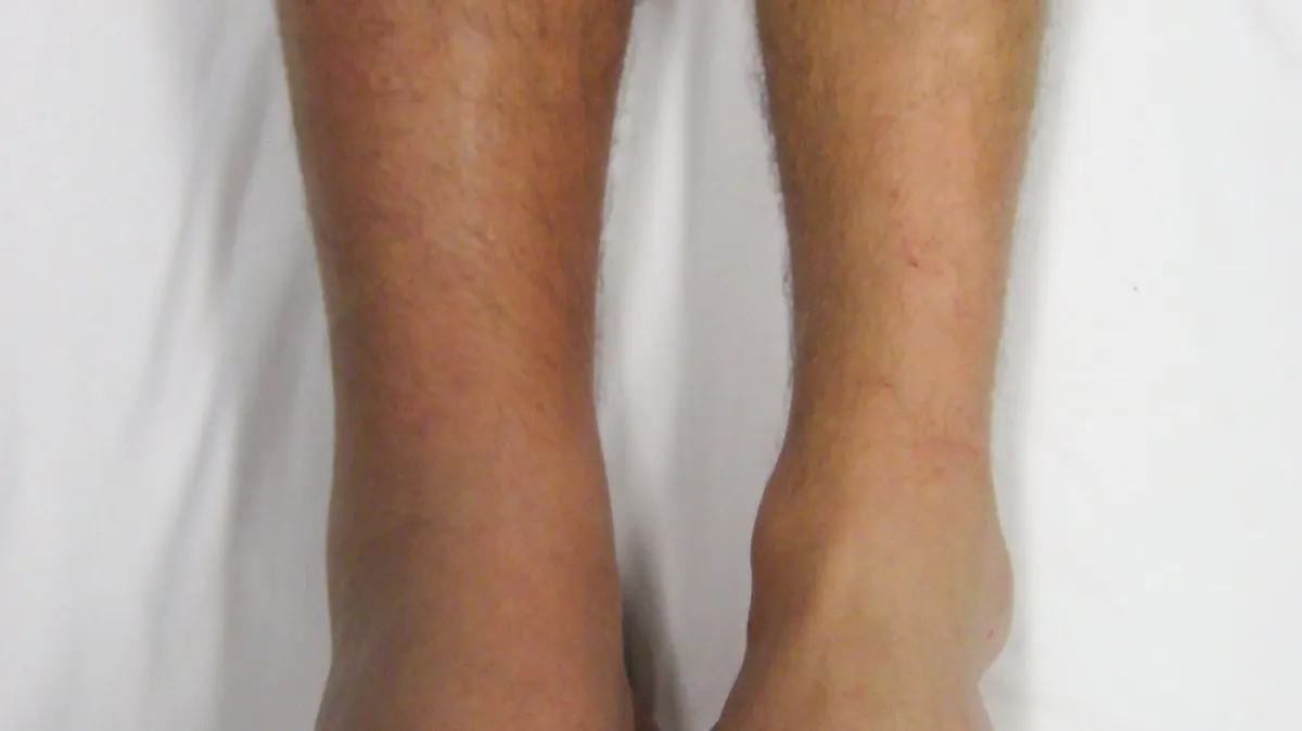 Swollen, reddish lower right leg and ankle beside a normal left leg, photographed from the front
