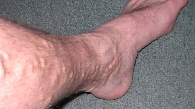 Close-up of a bare lower leg and ankle on a grey carpet with raised, rope-like veins visible under the skin