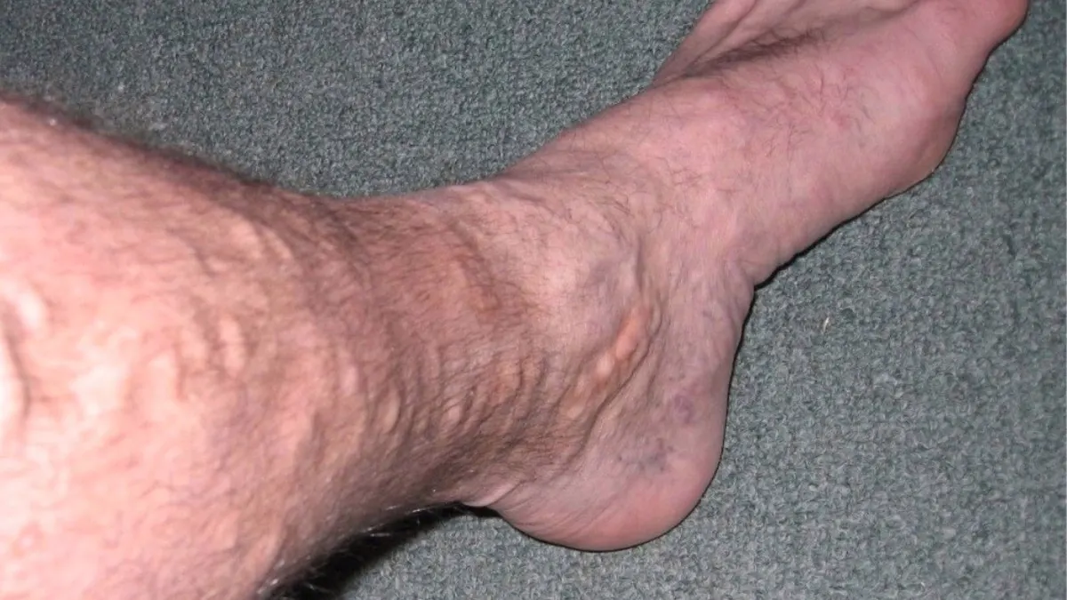 Close-up of a bare lower leg and ankle on a grey carpet with raised, rope-like veins visible under the skin