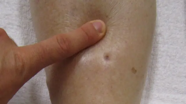 A finger pressing into a swollen lower leg, leaving a visible dent in the skin