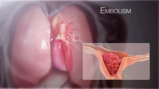 3D illustration of lungs and heart with an enlarged inset showing a blood clot inside a lung artery