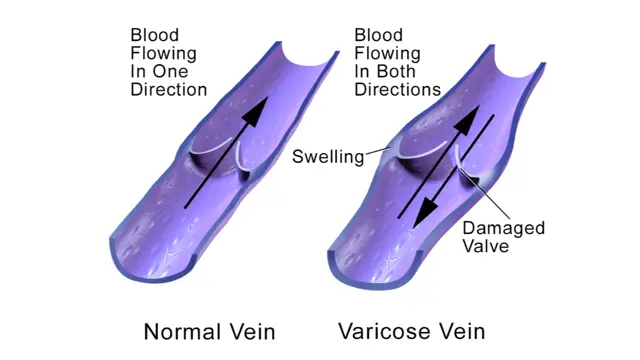 Diagram comparing a normal vein, with blood flowing one way, and a vein with a damaged valve, with blood flowing both ways