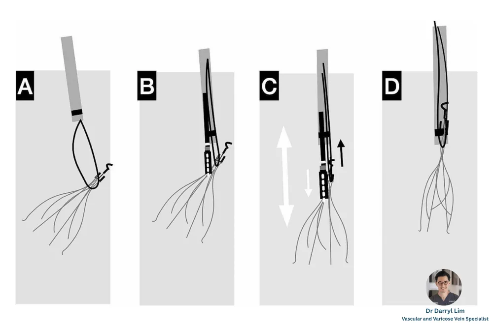 Diagram empat langkah filter IVC yang dilepaskan dari tabung tipis dan membuka di dalam vena
