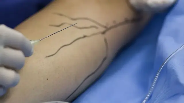 Gloved hands holding a fine needle beside a leg with surface veins marked in pen on blue drapes