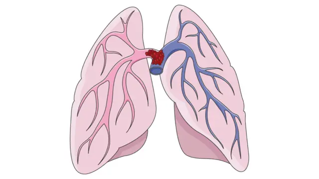 Illustration of a blood clot blocking the main pulmonary artery inside a pair of pink lungs
