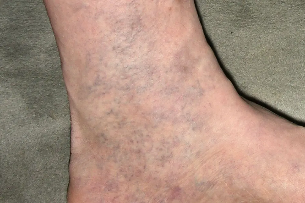 Side view of a bare ankle and foot showing a fine network of small bluish thread veins on the skin