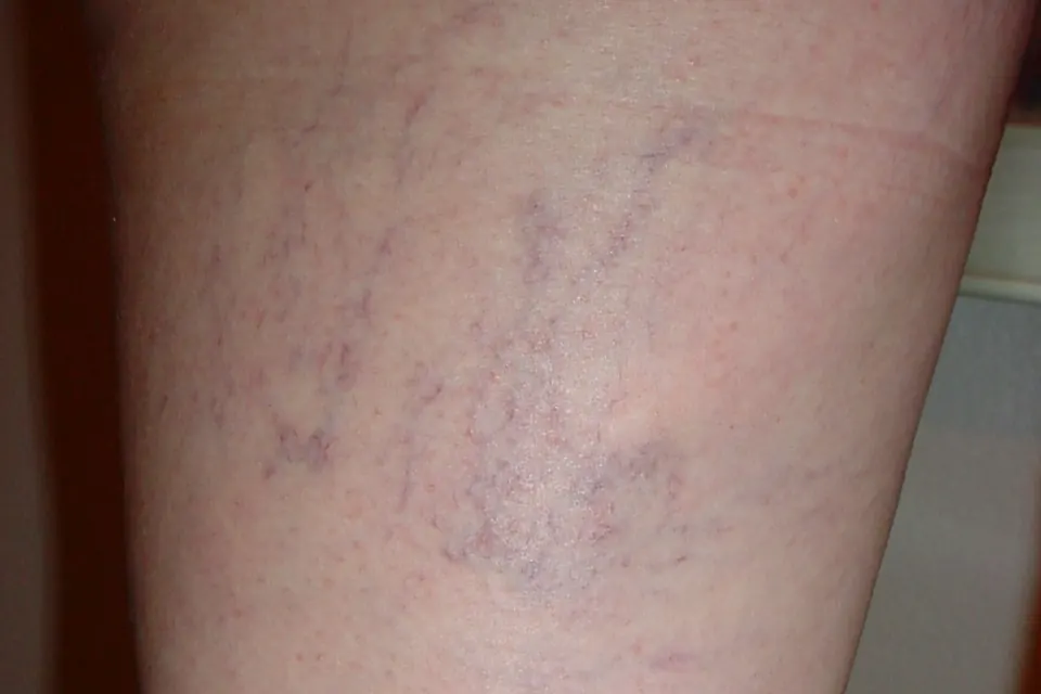 Fine purple and red thread-like veins visible on the skin of a pale thigh