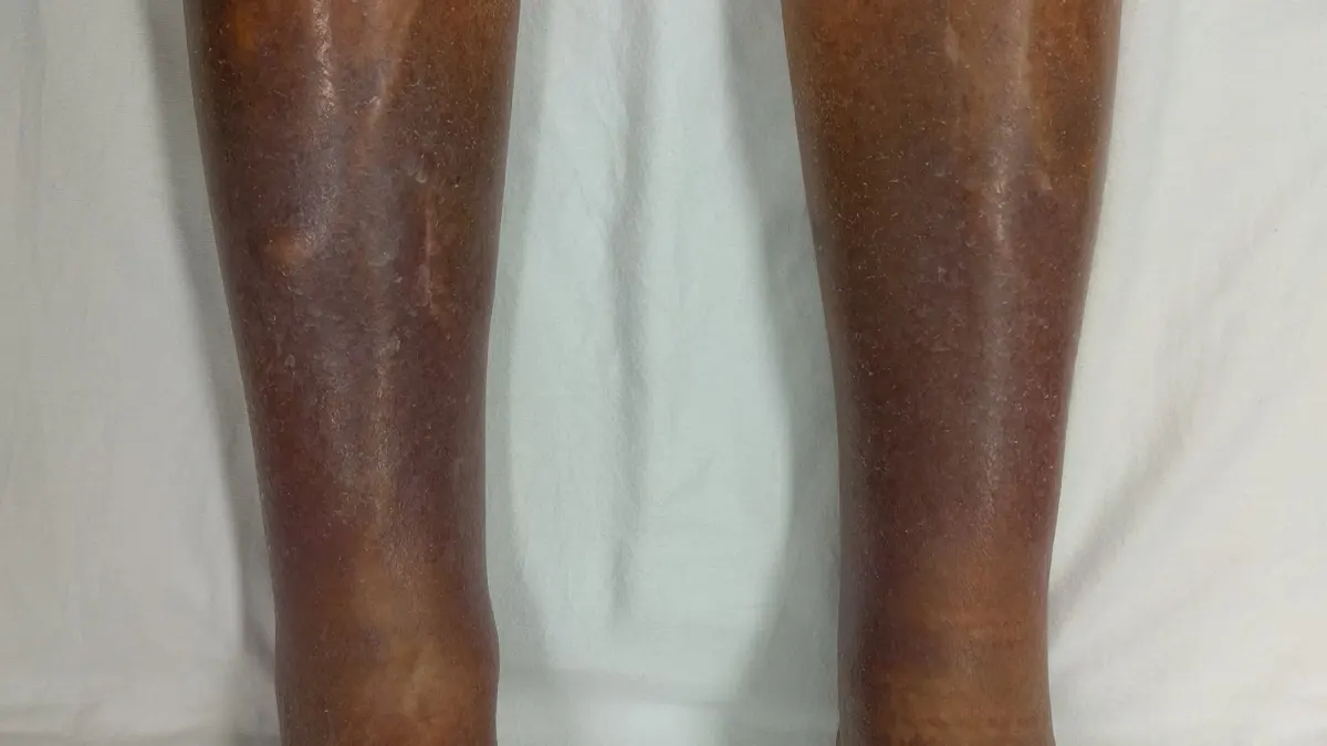 Front view of two bare lower legs with dark brown and purplish, dry, scaly skin against a white sheet