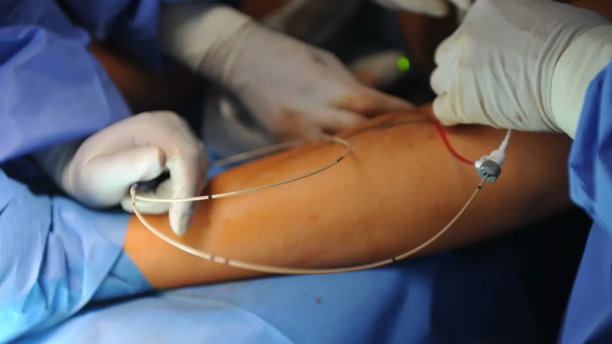 Gloved hands guiding a thin catheter along a leg during a minimally invasive vein procedure, with blue surgical drapes