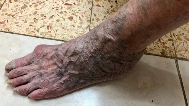 Dark, twisting veins and skin discolouration visible across the top of a bare foot and ankle resting on a tiled floor