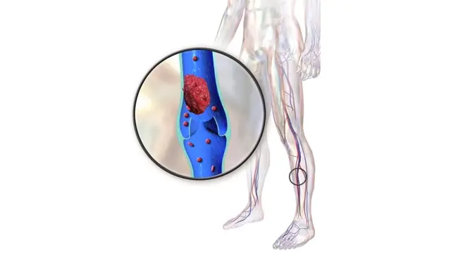 Illustration of a transparent human leg with a magnified deep vein showing a blood clot above a vein valve