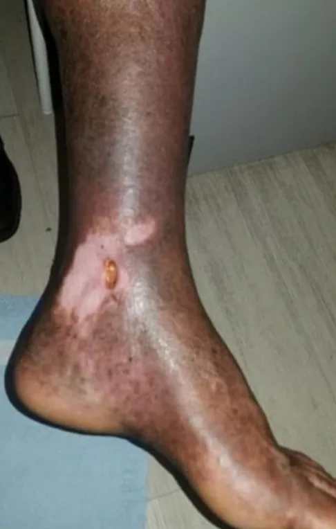 Ulkus vena kecil di dekat mata kaki bagian dalam pada kulit yang menggelap dan berpigmen